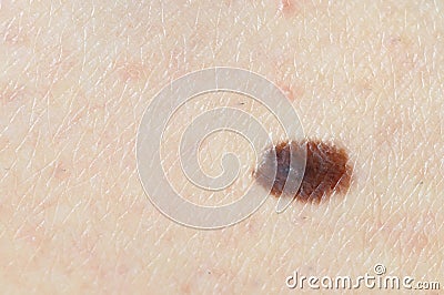 Brown birthmark (nevus) on Caucasian woman leg. Stock Photo