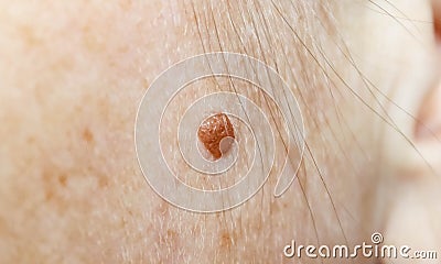 Brown birthmark on a woman`s face near the ear Stock Photo