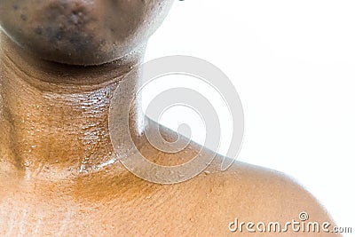 Brown skin sweating neck and chest Stock Photo