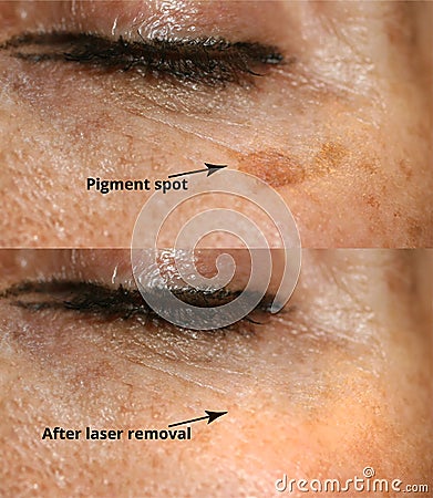 Brown spot on the skin of the face. Pigmentation on the skin. After laser removal Stock Photo