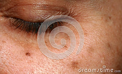 Brown spots on the face. Pigmentation on the skin. Brown age spots on the cheek. Stock Photo