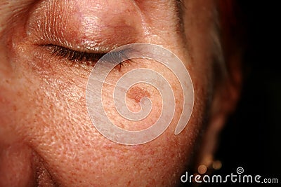 Brown spots under the eye. Pigmentation on the face Stock Photo