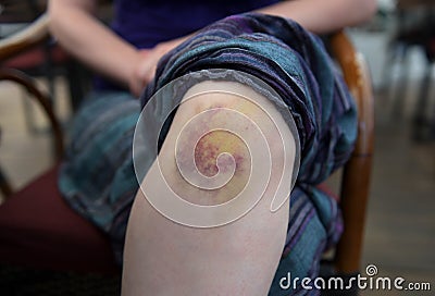 Bruise on knee, closeup shot Stock Photo