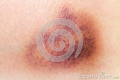 Bruise on skin Stock Photo