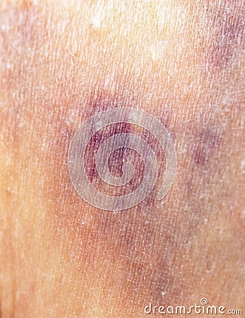 Bruise on the skin Stock Photo