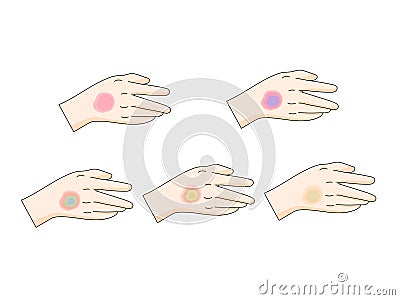 bruise stages diagram medical science Vector Illustration