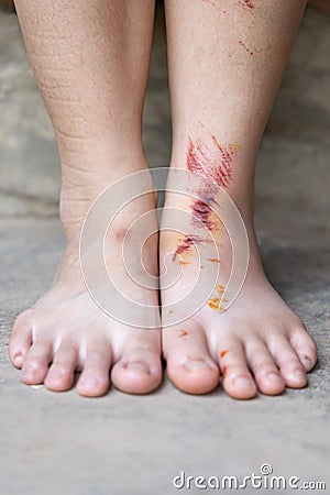 Bruise wound on woman`s feet Stock Photo