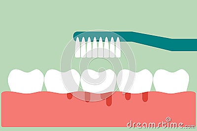 Brushing teeth with bleeding on gum and tooth concept gingivitis or scurvy Vector Illustration