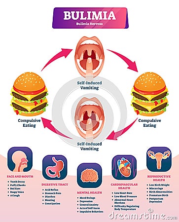 Bulimia vector illustration. Labeled self induced vomiting diagnosis scheme Vector Illustration