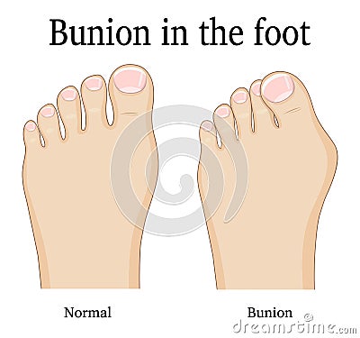 Bunion in the foot Vector Illustration