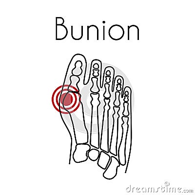 Bunion in foot vector illustration Vector Illustration