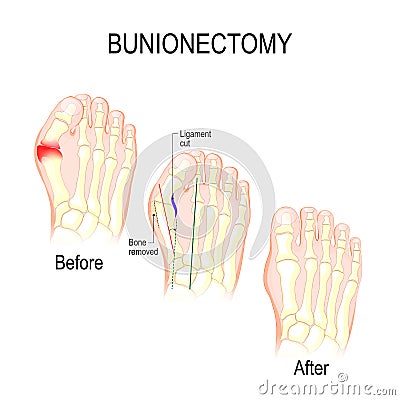 Bunionectomy. surgery to correct pathologies of the foot. Vector Illustration