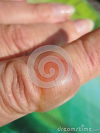 Burn finger Stock Photo