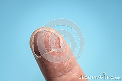 Burn on finger, biometrics problems concept. In the photo, the real fingerprint was distorted Stock Photo
