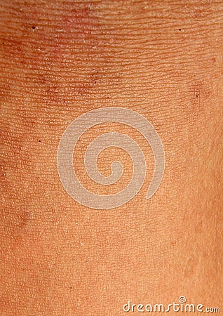 A burn scar that is partly healed Stock Photo