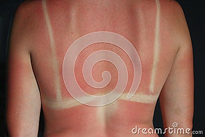 Burn from the sun on the body Stock Photo