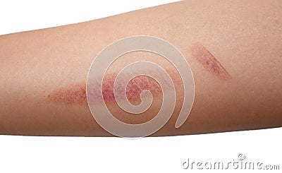 Burn wound on skin. Stock Photo