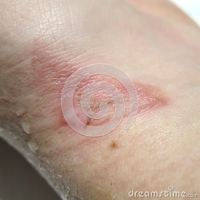 Burn on Wrist Stock Photo