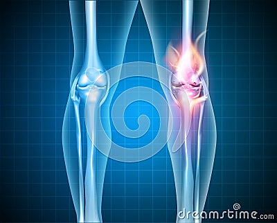 Burning knee Vector Illustration