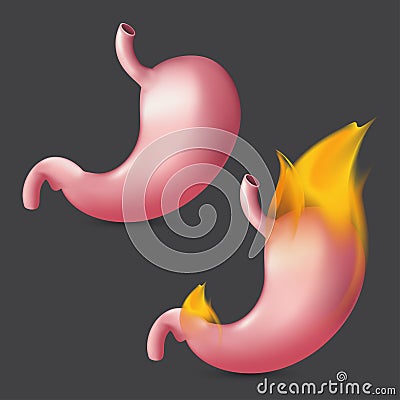 Burning stomach. Realistic human organ of internal digestion system on fire. Vector illustration of heartburn digestive, gastric Vector Illustration