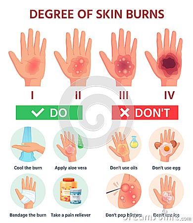 Burns degree. First aid for burn wound. Fire damage to skin classification. Hand blisters. Vector infographic treatment Vector Illustration