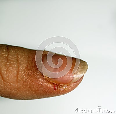 Burrs on the finger. Inflammation and abscess. Stock Photo