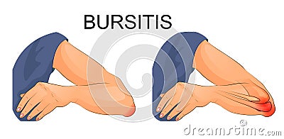 Bursitis of the elbow joint Vector Illustration