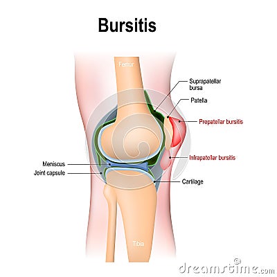 Bursitis is the inflammation of bursae Vector Illustration