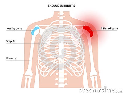 Bursitis inflammation concept Vector Illustration