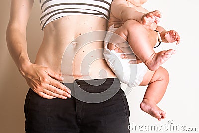C section Cesarean operation heal after Stock Photo