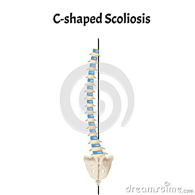 C-shaped scoliosis. Dextroscoliosis. Levoscoliosis. Spinal curvature, kyphosis, lordosis, scoliosis, arthrosis Vector Illustration