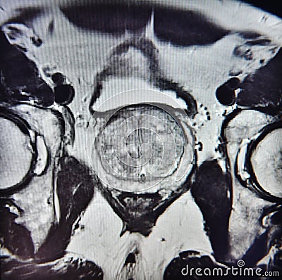 Ca prostate mri exam diagnostic Stock Photo