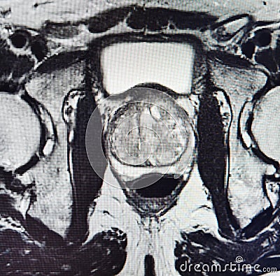 Ca prostate mri exam diagnostic Stock Photo