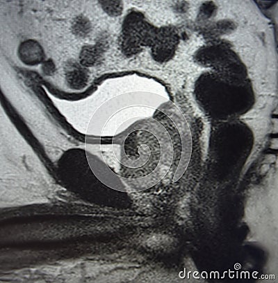 Ca prostate mri exam diagnostic Stock Photo