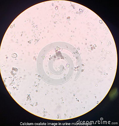Calcium oxalate image in urine microscopic Stock Photo