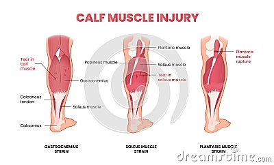 calf muscle injury infographic Vector Illustration