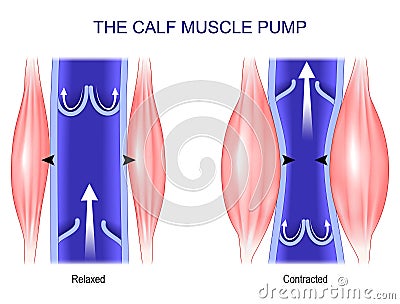 Calf muscle pump. Venous Health Vector Illustration