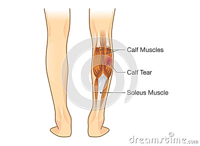 Calf muscle tear. Vector Illustration