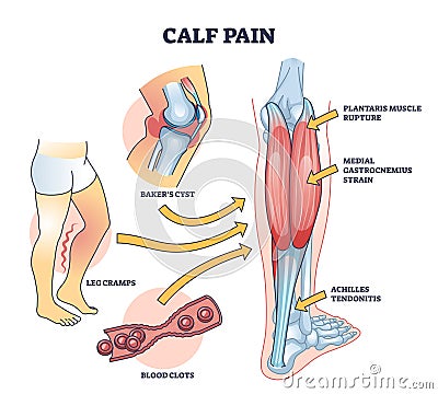 Calf pain explanation with cramp from muscle contraction outline diagram Vector Illustration