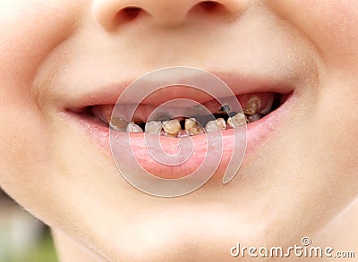 Calf's Teeth decay Toothache Stock Photo