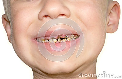 Calf's Teeth decay Toothache Stock Photo