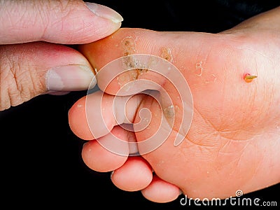 Callus on childs foot Stock Photo
