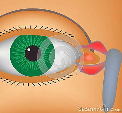 Canaliculitis. Inflammation of lacrimal canals. The structure of the eye. Infographics. Vector illustration. Vector Illustration