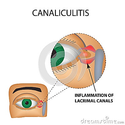 Canaliculitis Vector Illustration