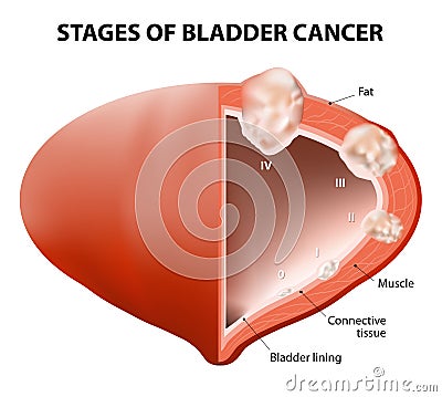 Cancer bladder Vector Illustration