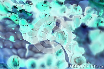 Cancer cells under the microscope. Tissues affected by cancer cells under a microscope, Science. Cancer medicine. chemistry and Stock Photo