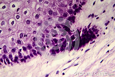 Cancer of cervix. Light micrograph of cervical biopsy. Photo under microscope Stock Photo