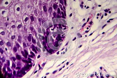 Cancer of cervix. Light micrograph of cervical biopsy. Photo under microscope Stock Photo