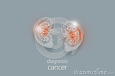 Cancer kidney disease or renal cell carcinomas. Malignant kidney tumors. Stock Photo