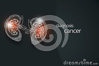 Cancer kidney disease or renal cell carcinomas. Malignant kidney tumors. Stock Photo